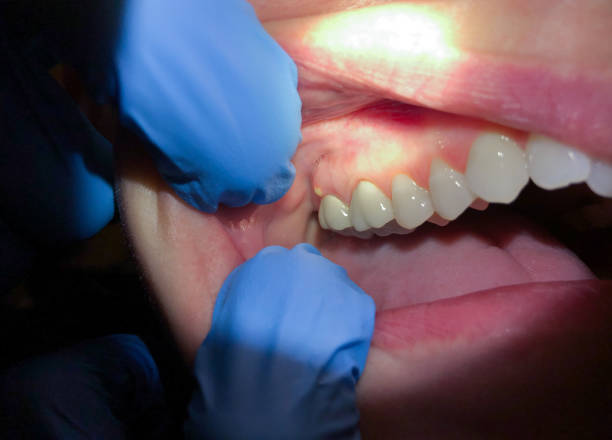 Best Emergency Root Canal Treatment in Marienville, PA